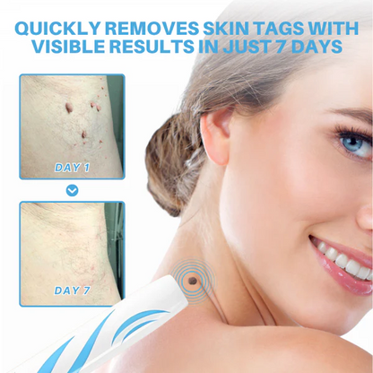 Painless Skin Tag Removal Pen – Home Precision Care Tool